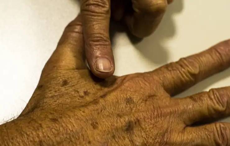 DEZEMBRO LARANJA: mutirão vai disponibilizar 700 atendimentos em prevenção contra o câncer de pele